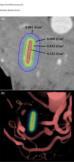 (a) A single axial slice of the pancreas from the pre-treatment CT scans is overlaid with computed contours of light fluence levels around the fiber location. This was simulated using blood content information for tissue absorption from contrast CT. (b) A volume rendering of the blood vessels around the pancreas overlaid with the light dose map in the fiber location, in the same patient. Please see supplementary material at 