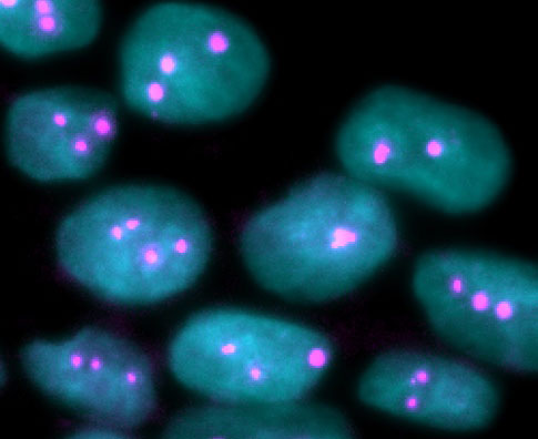 Fluorescent in-situ hybridization of hPSCs with a probe for chromosome 17 (magenta) showing that the population is a mix of diploid and aneuploid cells (image A. Ya).