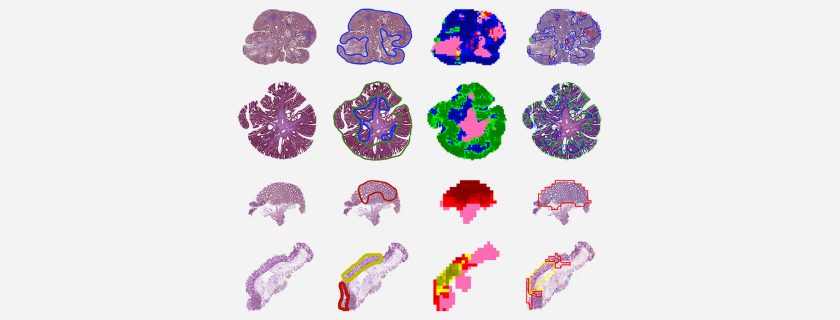 New AI Model Accurately Classifies Colorectal Polyps Using Slides From 24 Institutions