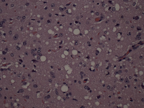 Brain section taken from an animal infected with in vitro-generated prions showing vacuolation and loss of neurons (40 x magnification)